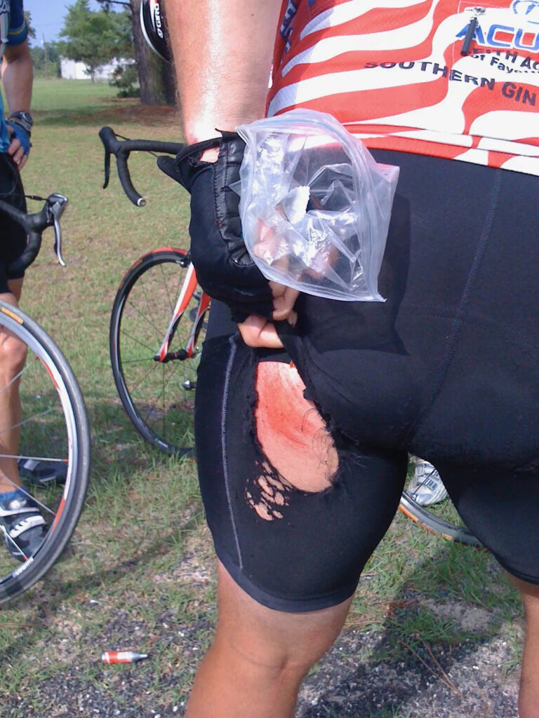 a cyclists upper thigh covered in cycling shorts which have been torn and show a bloody red road rash on the very top of the thigh.